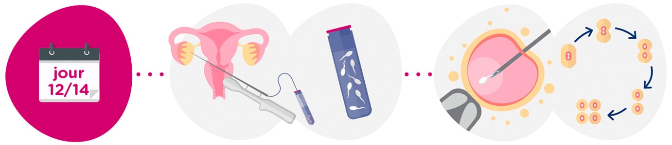 Recueil des ovocytes + échantillon de sperme
