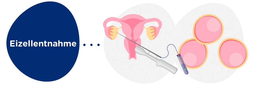 Eizellentnahme