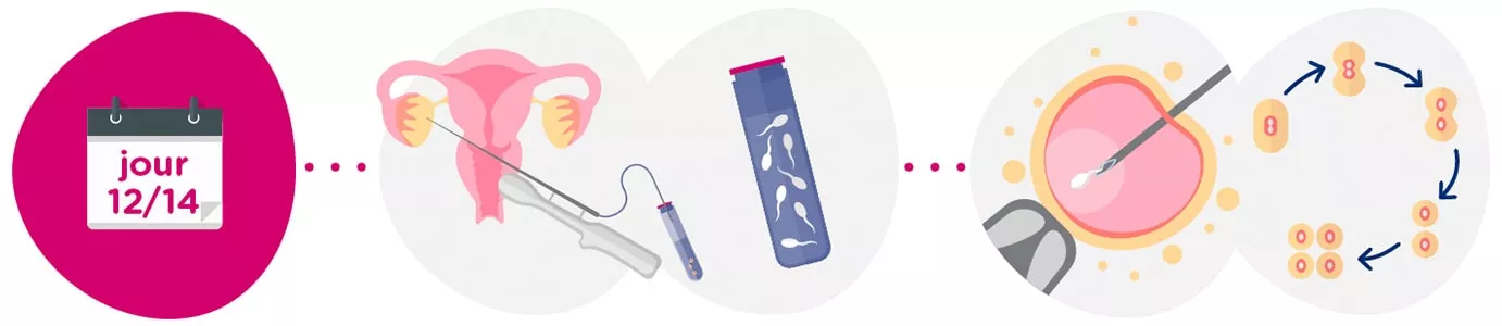 Recueil des ovocytes + échantillon de sperme
