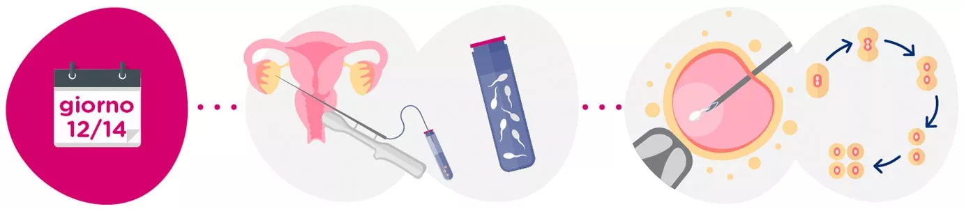 Prelievo degli ovociti + campione di sperma
