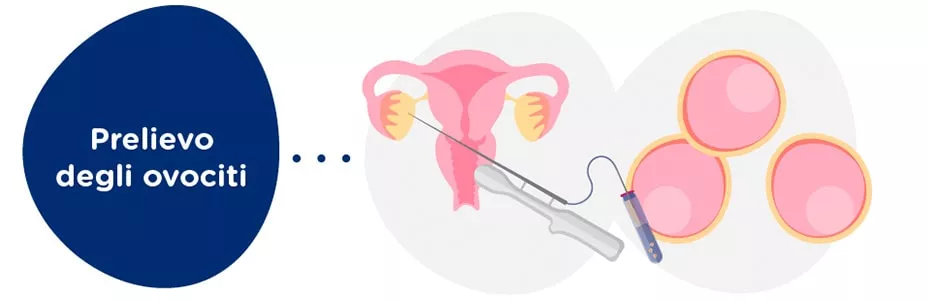 Prelievo degli ovociti