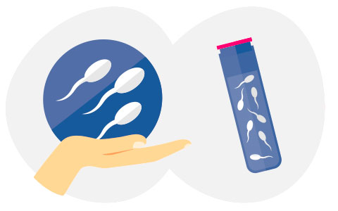 Préparation du sperme d’un donneur