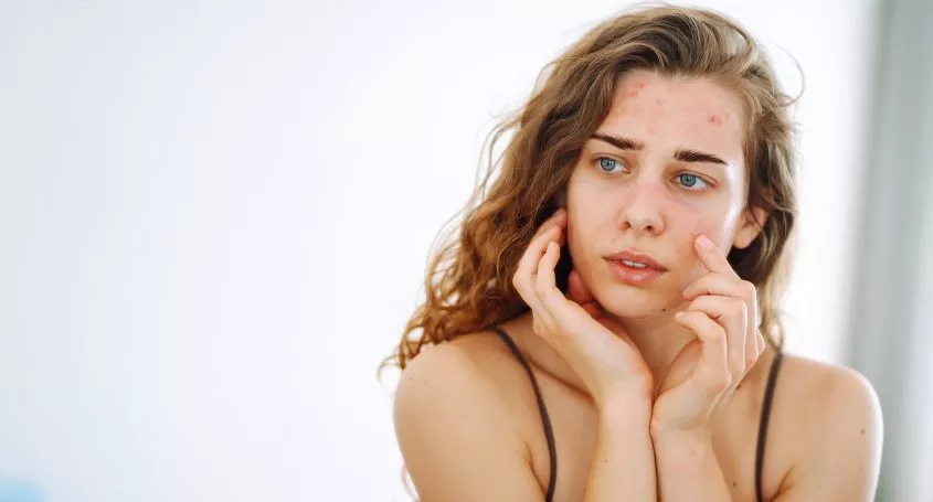 Hyperandrogenism and fertility: symptoms, causes and treatments